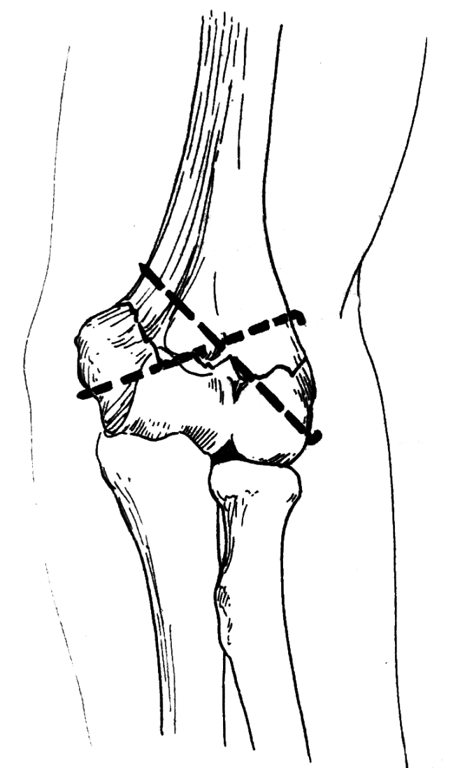 【PNG素材网-png.mixinnet.cn】肱骨踝上骨折手术钢针固定